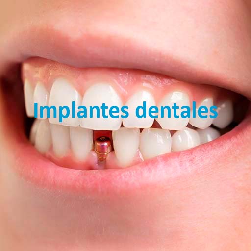 centro dental javier alvarez implantes dentales